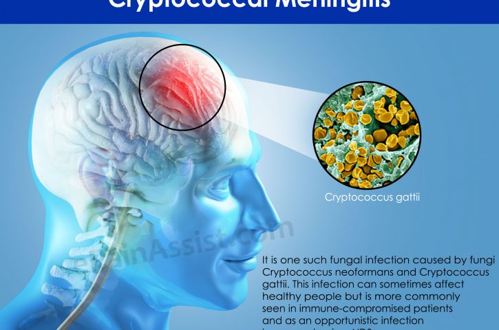 All You Need To Know About Meningitis